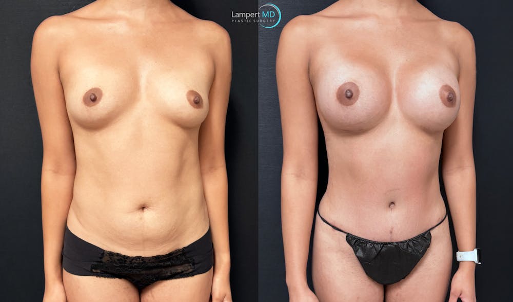 Tummy Tuck Before & After Gallery - Patient 196331 - Image 2