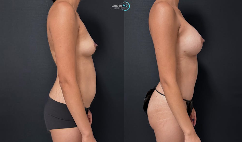Tummy Tuck Before & After Gallery - Patient 196331 - Image 4