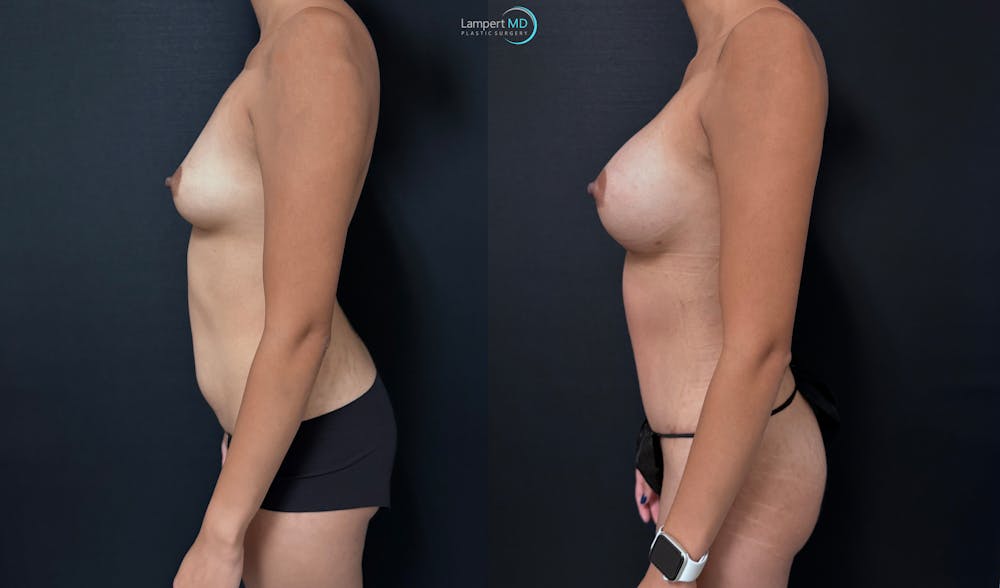 Tummy Tuck Before & After Gallery - Patient 196331 - Image 5
