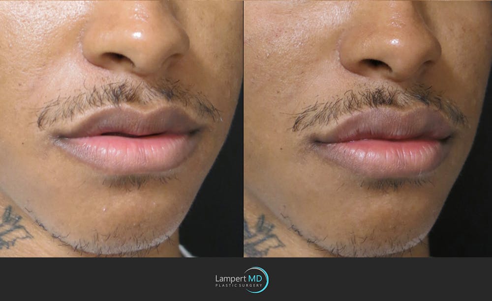 Lip Augmentation Before & After Gallery - Patient 122909251 - Image 2