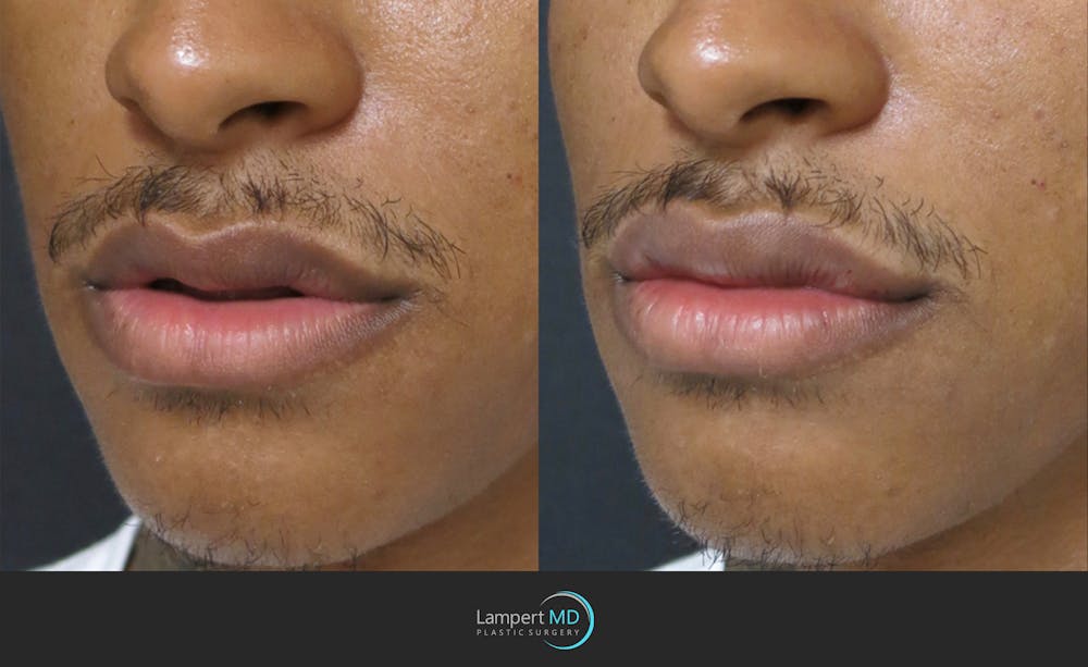 Lip Augmentation Before & After Gallery - Patient 122909251 - Image 3