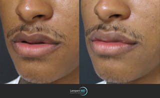 Lip Augmentation Before & After Gallery - Patient 122909251 - Image 3