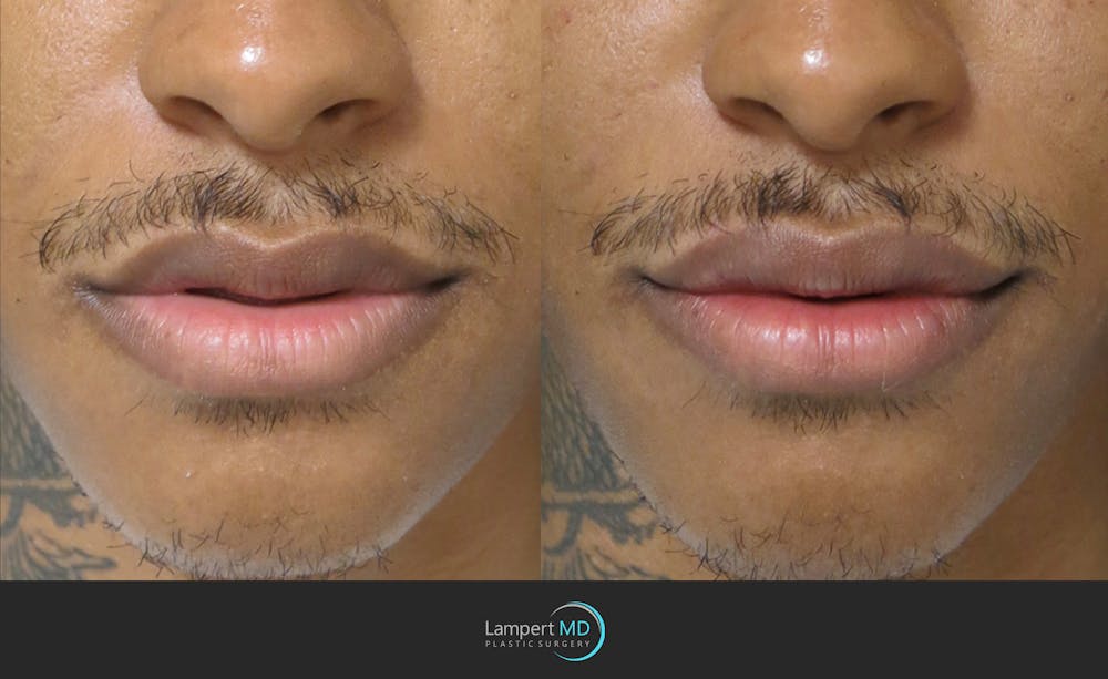 Lip Augmentation Before & After Gallery - Patient 122909251 - Image 1