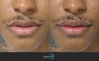 Lip Augmentation Before & After Gallery - Patient 122909251 - Image 1