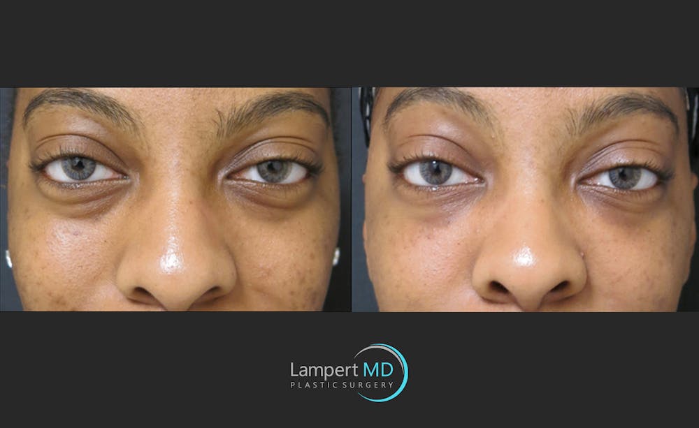 Fillers Before & After Gallery - Patient 122909183 - Image 1
