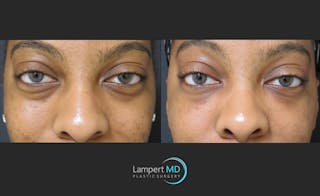 Fillers Before & After Gallery - Patient 122909183 - Image 1