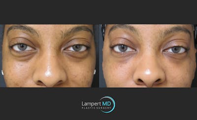 Fillers Before & After Gallery - Patient 122909183 - Image 1