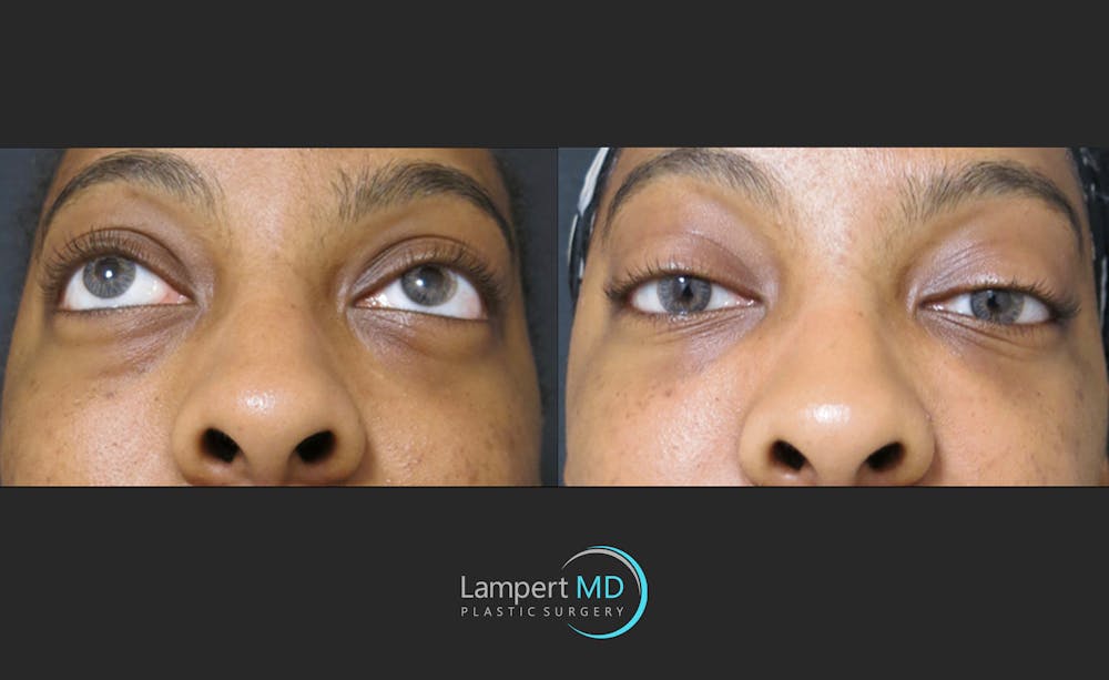 Fillers Before & After Gallery - Patient 122909183 - Image 4