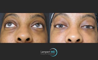 Fillers Before & After Gallery - Patient 122909183 - Image 4