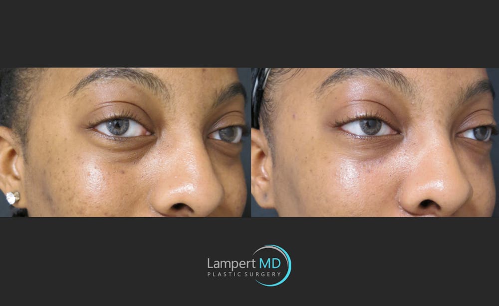Fillers Before & After Gallery - Patient 122909183 - Image 2