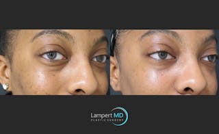 Fillers Before & After Gallery - Patient 122909183 - Image 2