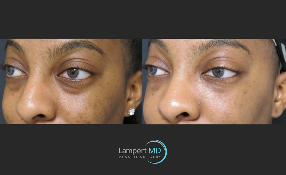 Fillers Before & After Gallery - Patient 122909183 - Image 3