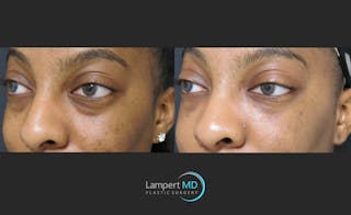 Fillers Before & After Gallery - Patient 122909183 - Image 3