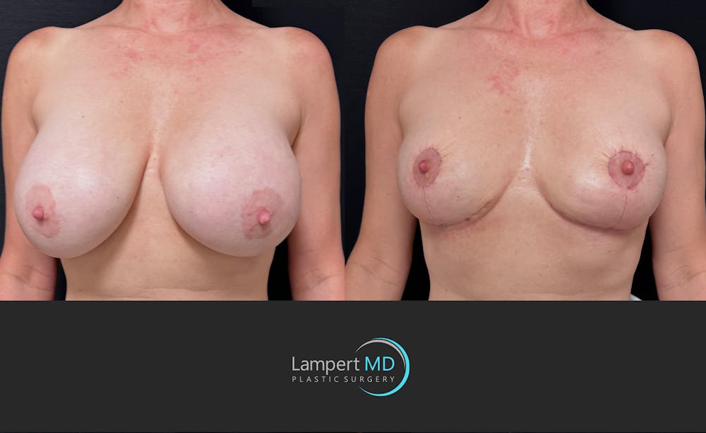 Breast Explant Before & After Gallery - Patient 426800 - Image 2