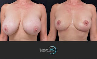 Breast Explant Before & After Gallery - Patient 426800 - Image 2