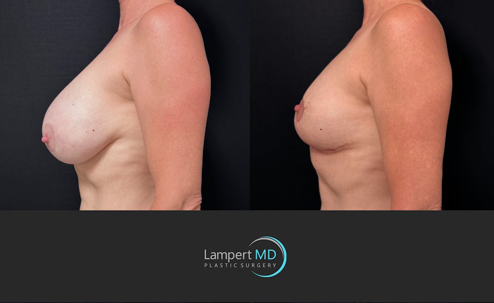 Breast Explant Before & After Gallery - Patient 426800 - Image 5