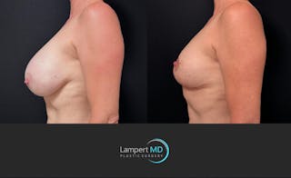 Breast Explant Before & After Gallery - Patient 426800 - Image 5
