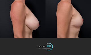 Breast Explant Before & After Gallery - Patient 426800 - Image 4