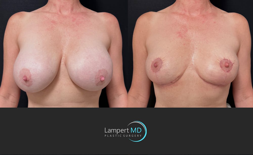 Breast Explant Before & After Gallery - Patient 426800 - Image 1