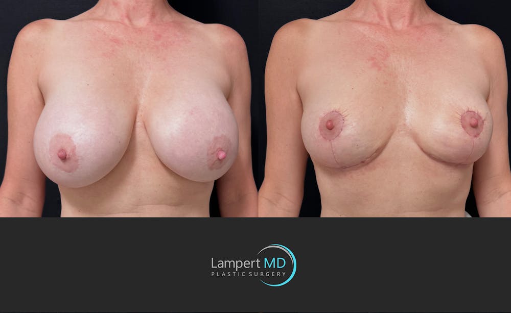 Breast Explant Before & After Gallery - Patient 426800 - Image 3