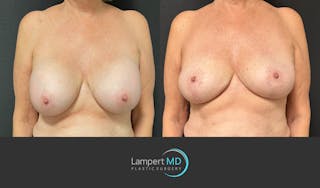 Breast Explant Before & After Gallery - Patient 266509 - Image 1
