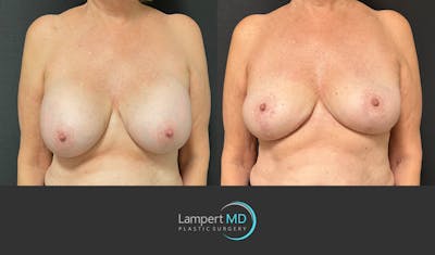 Breast Explant Before & After Gallery - Patient 266509 - Image 1