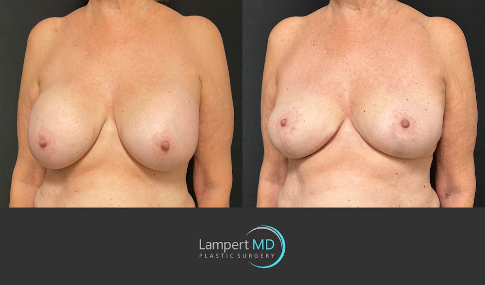 Breast Explant Before & After Gallery - Patient 266509 - Image 2