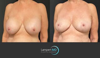 Breast Explant Before & After Gallery - Patient 266509 - Image 2