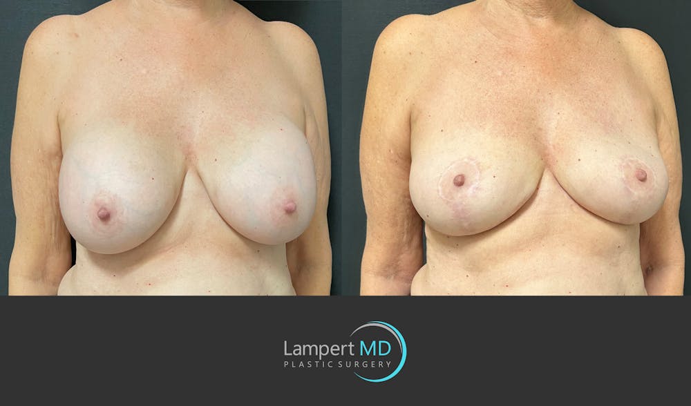 Breast Explant Before & After Gallery - Patient 266509 - Image 3