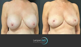 Breast Explant Before & After Gallery - Patient 266509 - Image 3