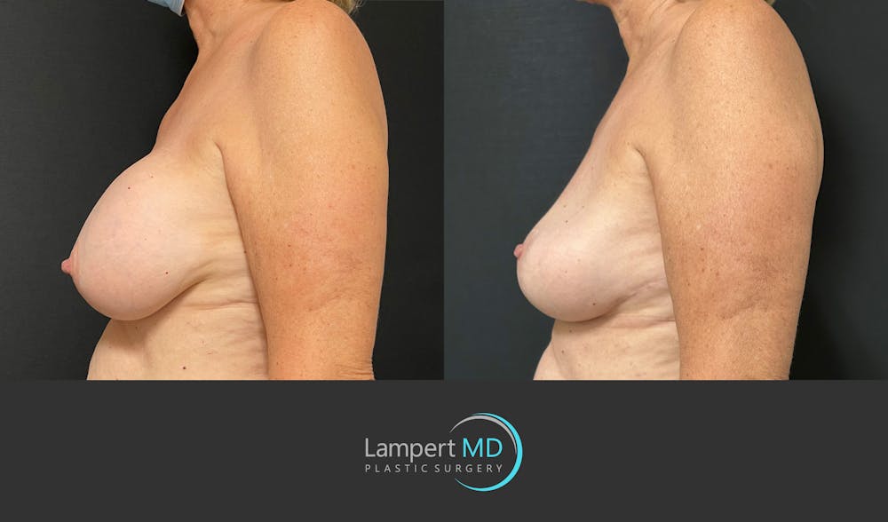 Breast Explant Before & After Gallery - Patient 266509 - Image 5