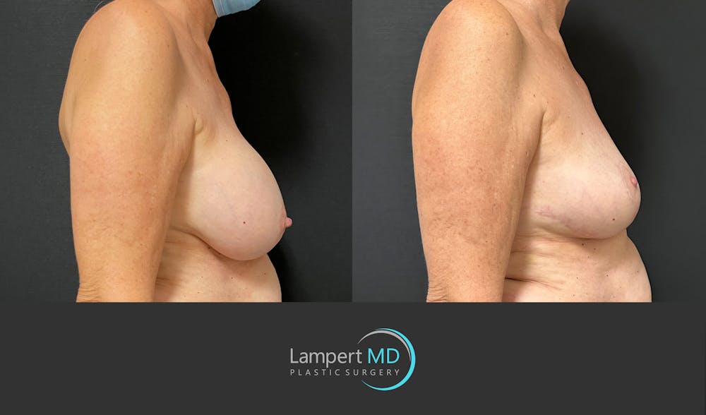 Breast Explant Before & After Gallery - Patient 266509 - Image 4