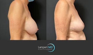Breast Explant Before & After Gallery - Patient 266509 - Image 4