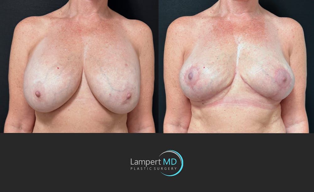 Breast Explant Before & After Gallery - Patient 167179 - Image 1
