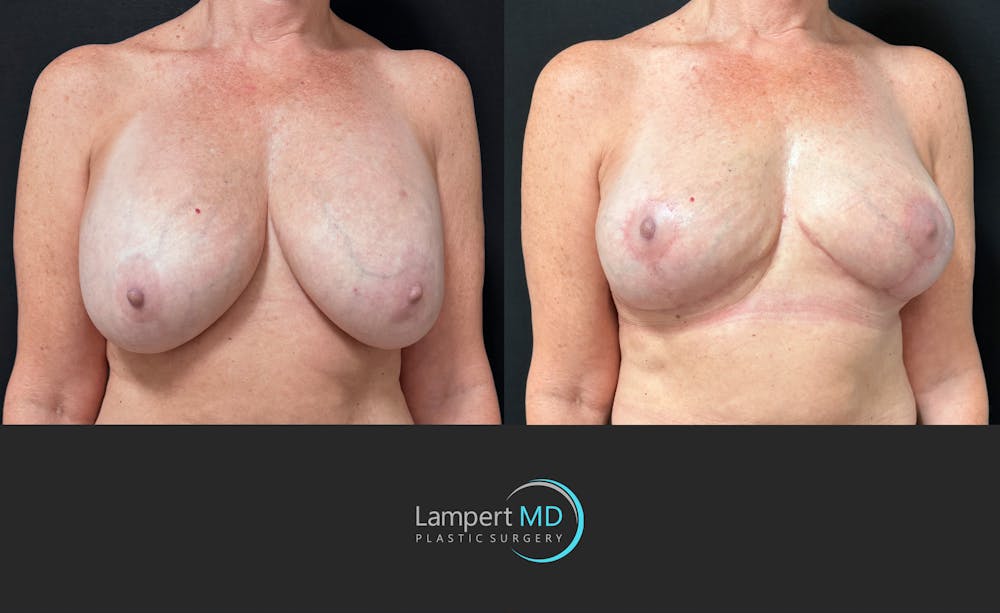 Breast Explant Before & After Gallery - Patient 167179 - Image 3