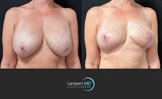 Breast Explant Before & After Gallery - Patient 167179 - Image 3