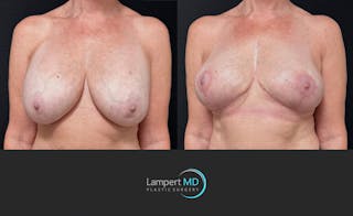 Breast Explant Before & After Gallery - Patient 167179 - Image 2