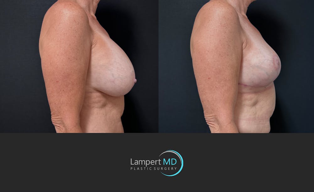 Breast Explant Before & After Gallery - Patient 167179 - Image 4