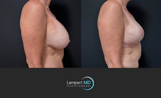 Breast Explant Before & After Gallery - Patient 167179 - Image 4