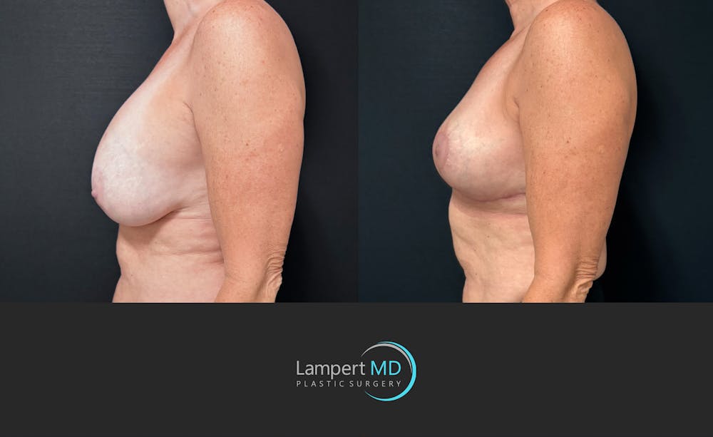 Breast Explant Before & After Gallery - Patient 167179 - Image 5
