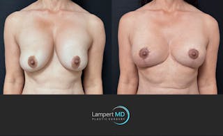Breast Explant Before & After Gallery - Patient 513850 - Image 1
