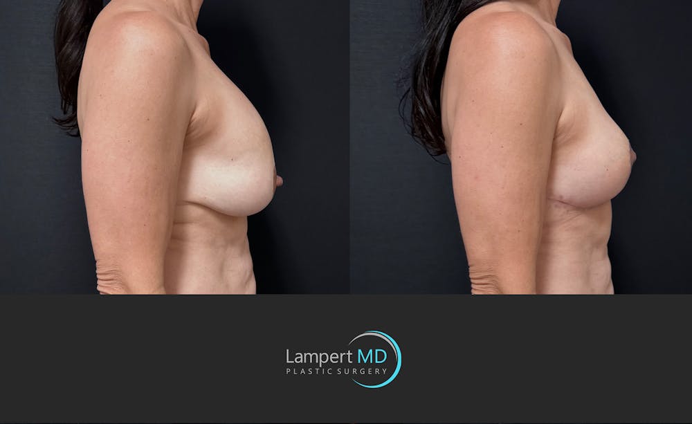 Breast Explant Before & After Gallery - Patient 513850 - Image 2