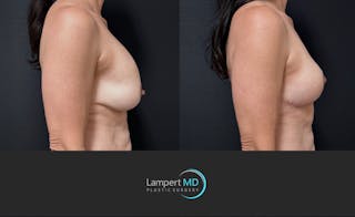 Breast Explant Before & After Gallery - Patient 513850 - Image 2