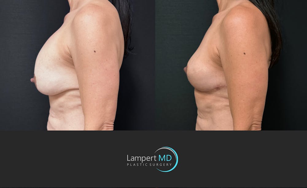 Breast Explant Before & After Gallery - Patient 513850 - Image 3