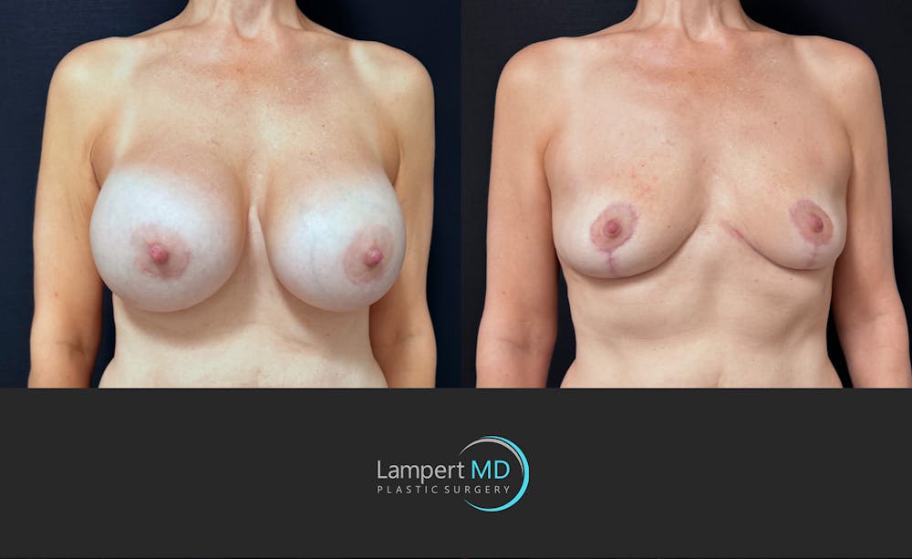 Breast Explant Before & After Gallery - Patient 318572 - Image 1