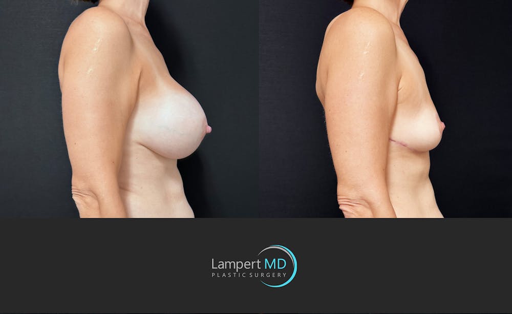 Breast Explant Before & After Gallery - Patient 318572 - Image 2