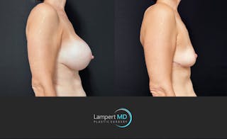 Breast Explant Before & After Gallery - Patient 318572 - Image 2