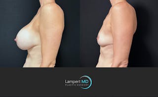 Breast Explant Before & After Gallery - Patient 318572 - Image 3