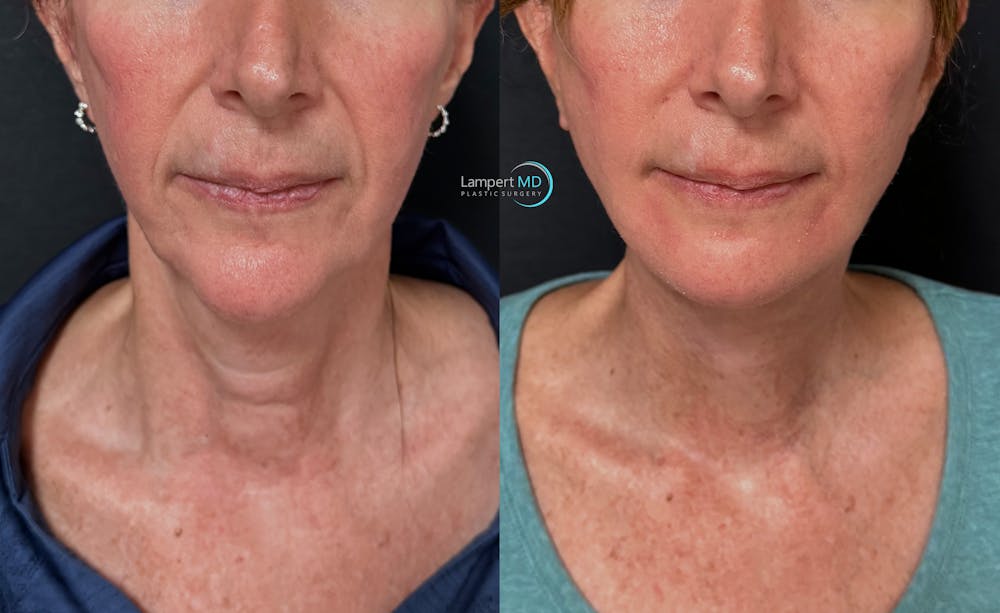 Face & Neck Lift Before & After Gallery - Patient 989129 - Image 1