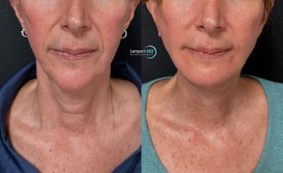 Face & Neck Lift Before & After Gallery - Patient 989129 - Image 1